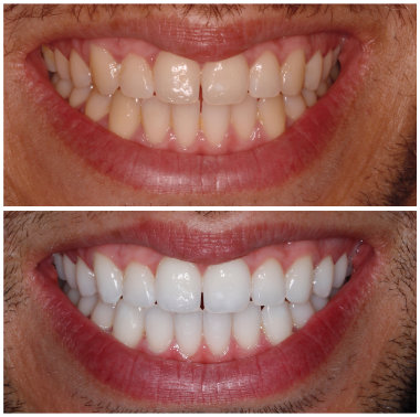 Clareamento Dental